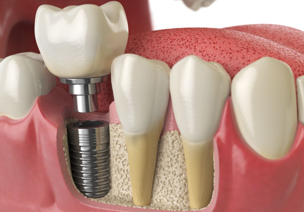 Generalitati despre implanturile dentare